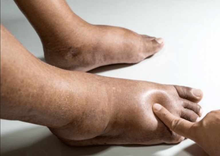 A drenagem deve sempre ser realizada por fisioterapeuta habilitado em linfoterapia